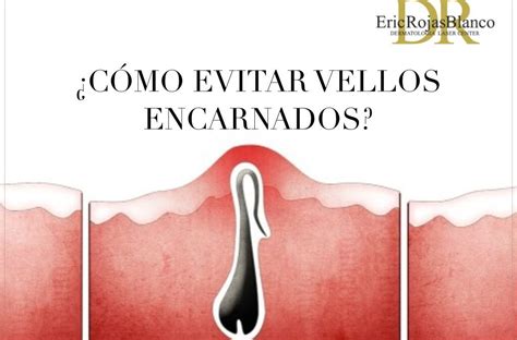 vellos encarnados genitales fotos|Vello encarnado: síntomas, causas, diagnóstico y tratamiento